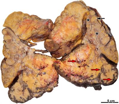 Angiomyolipoma of the kidney—Clinicopathological analysis of 52 cases